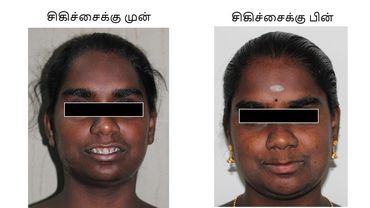 Orthognathic surgery / Facial cosmetic surgery