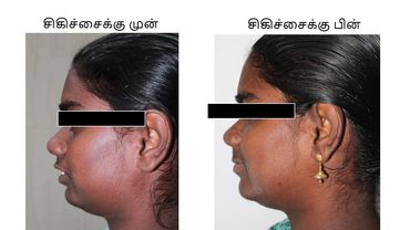 Orthognathic surgery / Facial cosmetic surgery