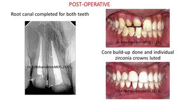 Root canal treatments