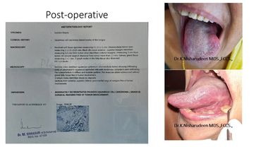 oral cancer treatment 
