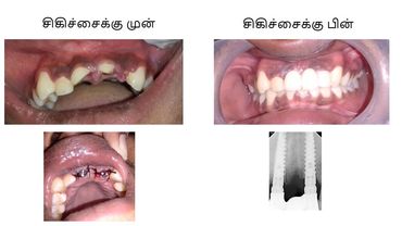 Dental implants 