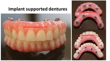 Full mouth Dental rehabilitation 
