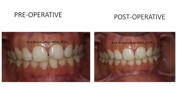 Tooth coloured fillings / Composites