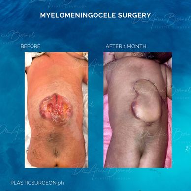 myelomeningocele before and after by Dr. Aicee Bernal top plastic surgeon in manila Philippines