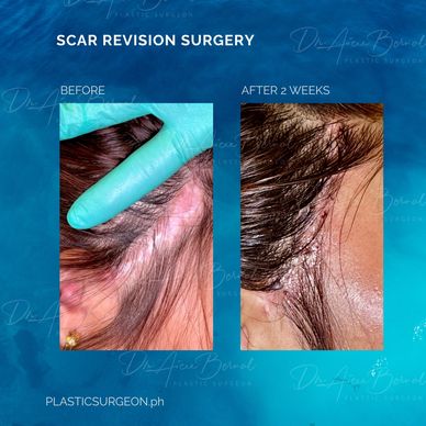 scar surgery before and after by Dr. Aicee Bernal top plastic surgeon in manila Philippines