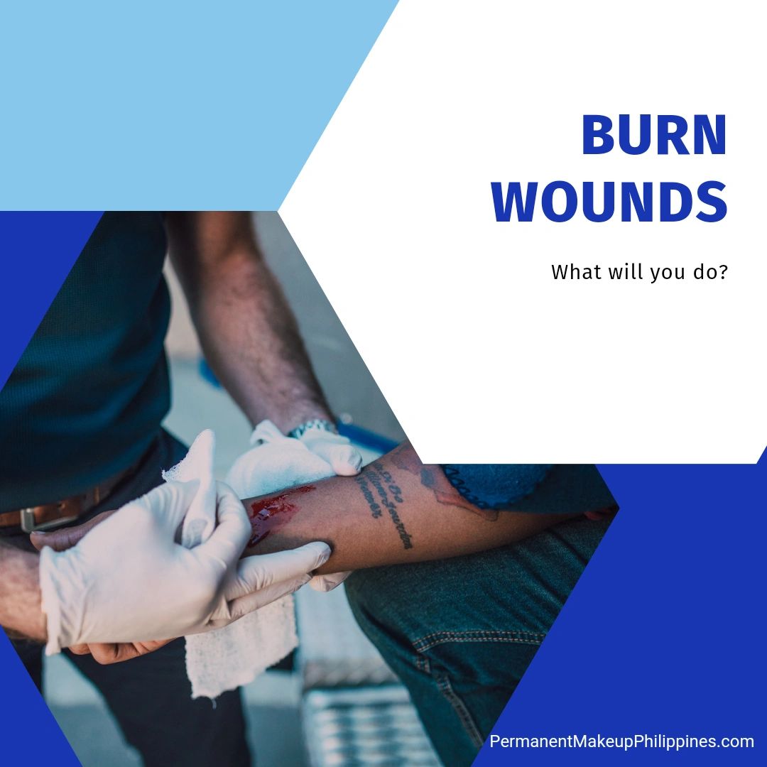 What to do when you get a burn wound?