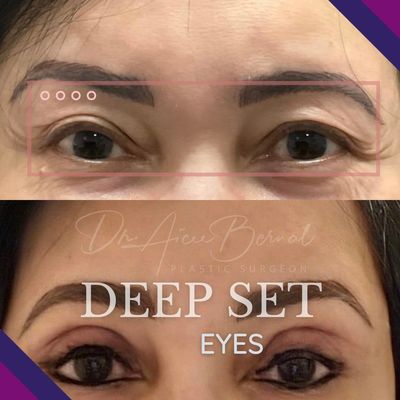 Before and after double eyelid surgery by Dr. Aicee Bernal, monolid correction in the Philippines