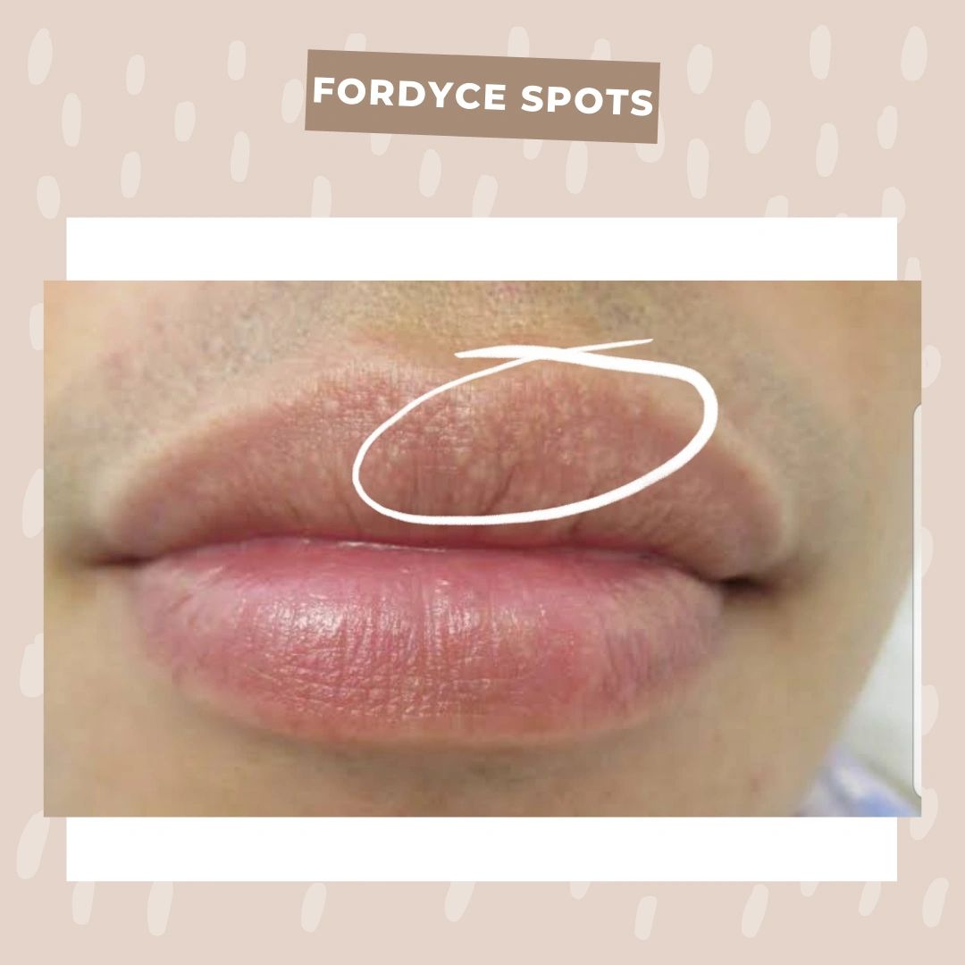 Can lip tattoo cover fordyce spots?