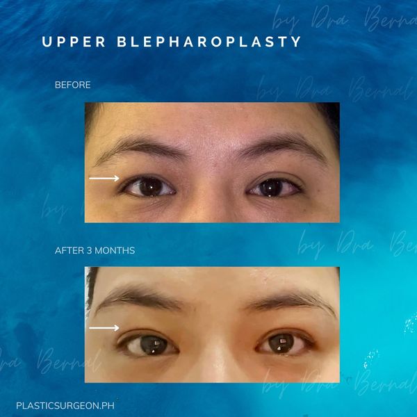 best plastic surgeon for Upper Blepharoplasty in Manila Philippines Dr. Aicee Bernal