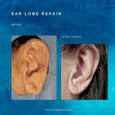 earring hole repair  before and after by Dr. Aicee Bernal top plastic surgeon in manila Philippines