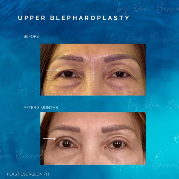 best plastic surgeon for Upper Blepharoplasty in Manila Philippines Dr. Aicee Bernal