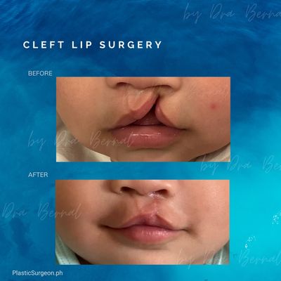 Before and after cleft lip surgery by Dr. Aicee Bernal, cheiloplasty results in the Philippines