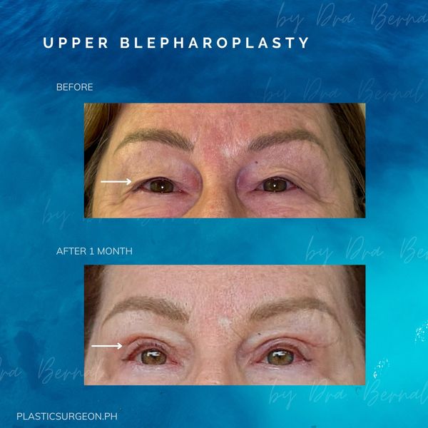 top plastic surgeon for Upper Blepharoplasty in Manila Philippines Dr. Aicee Bernal