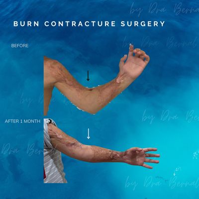burn contracture release by Dr. Aicee Bernal, burn reconstruction Philippines