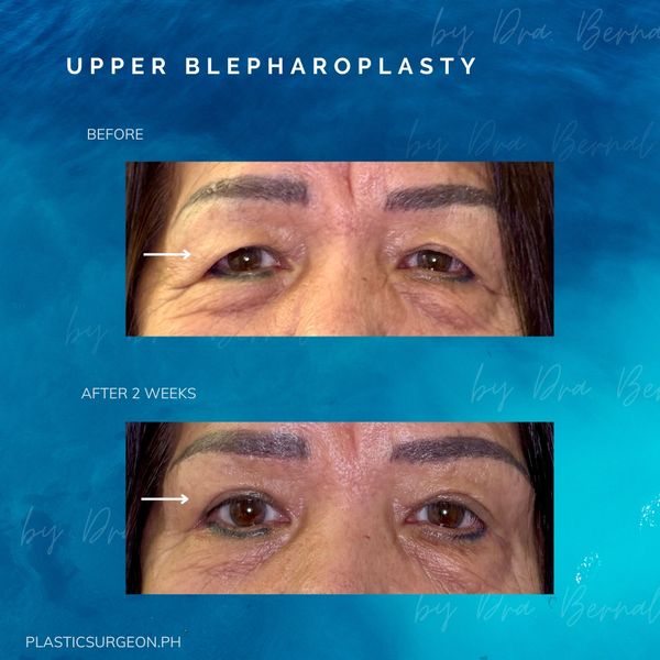 best plastic surgeon for Upper Blepharoplasty in Manila Philippines Dr. Aicee Bernal