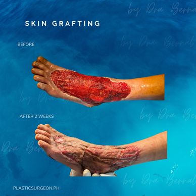 skin grafting before and after by Dr. Aicee Bernal top plastic surgeon in manila Philippines