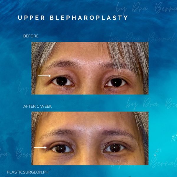 top plastic surgeon for Upper Blepharoplasty in Manila Philippines Dr. Aicee Bernal