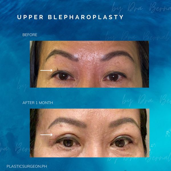 top plastic surgeon for Upper Blepharoplasty in Manila Philippines Dr. Aicee Bernal