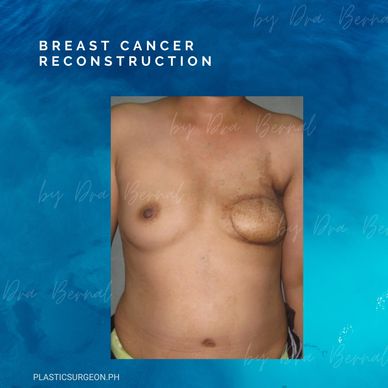 TRAM flap  before and after by Dr. Aicee Bernal top plastic surgeon in manila Philippines
