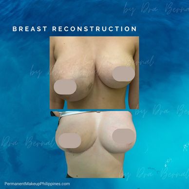 Breast reconstruction surgery before and after by Dr. Aicee Bernal top plastic surgeon in manila