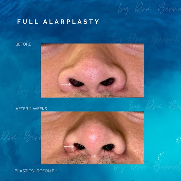 Before and after images of full alarplasty showing nostril shape improvement after 2 weeks.