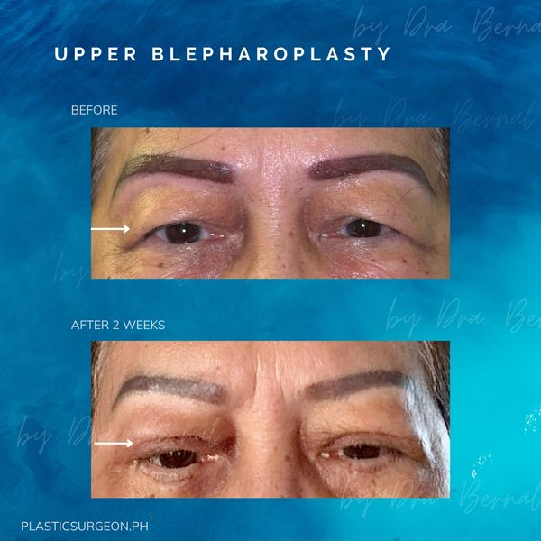 top plastic surgeon for Upper Blepharoplasty in Manila Philippines Dr. Aicee Bernal