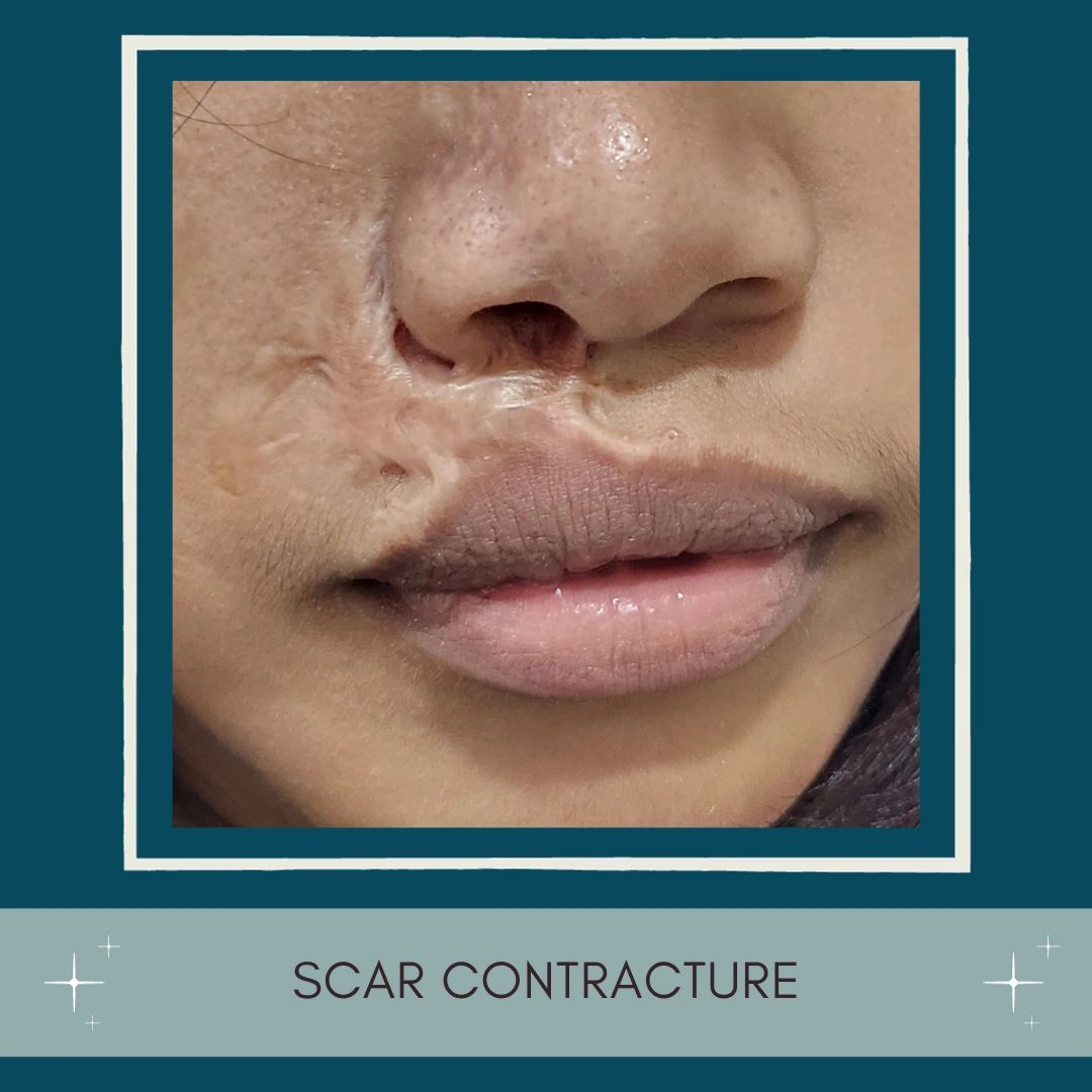 Scar contractures and how to treat them