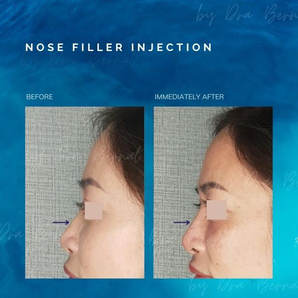 Nose  Filler before and after results by Dr. Aicee Bernal the best plastic surgeon in Manila