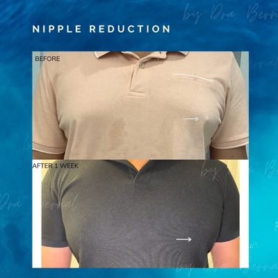 Nipple reduction surgery by Dr. Aicee Bernal, cosmetic transformation Philippines