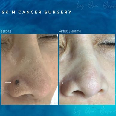 Skin cancer surgery before and after by Dr. Aicee Bernal top plastic surgeon in manila