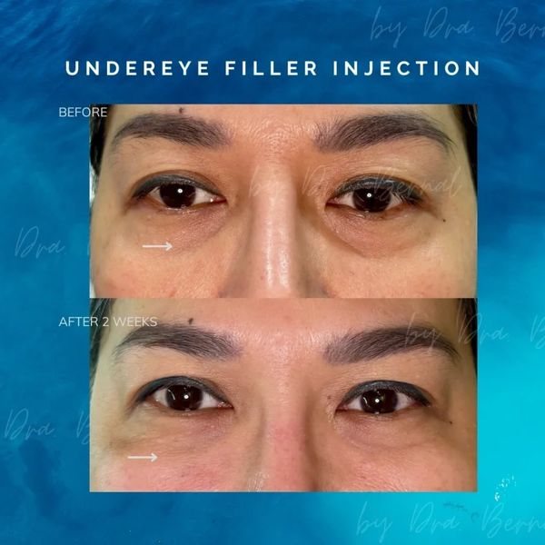 Underdeye Filler before and after results by Dr. Aicee Bernal best plastic surgeon in  Philippines