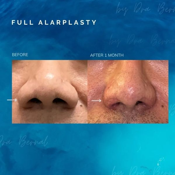Before and after alarplasty done by the best plastic surgeon Dr. Aicee Bernal