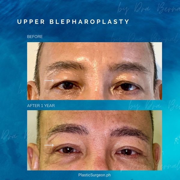 top plastic surgeon for Upper Blepharoplasty in Manila Philippines Dr. Aicee Bernal