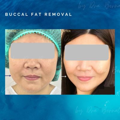 Before and after buccal fat removal by Dr. Aicee Bernal, cheek contouring surgery in the Philippines