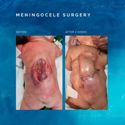 Myelomeningocele surgical repair by Dr. Aicee Bernal in the Philippines, pediatric plastic surgery