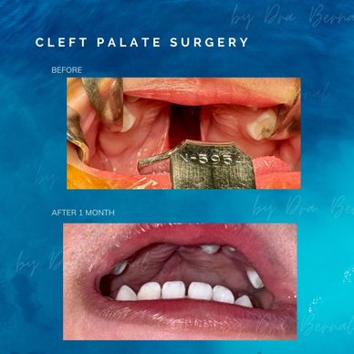 cleft palate surgery  before and after by Dr. Aicee Bernal top plastic surgeon in manila Philippines