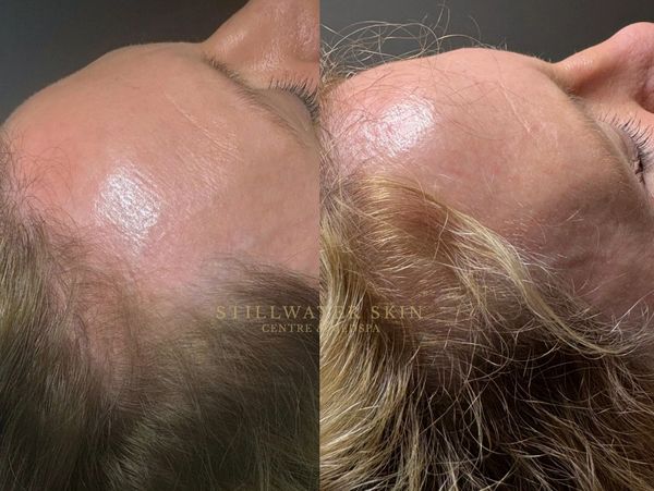 Side-by-side comparison of scalp with hair thinning and fuller hair.