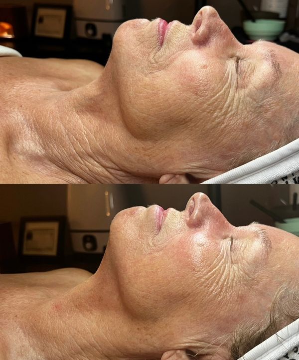 Anti-Aging "Botox" Facial