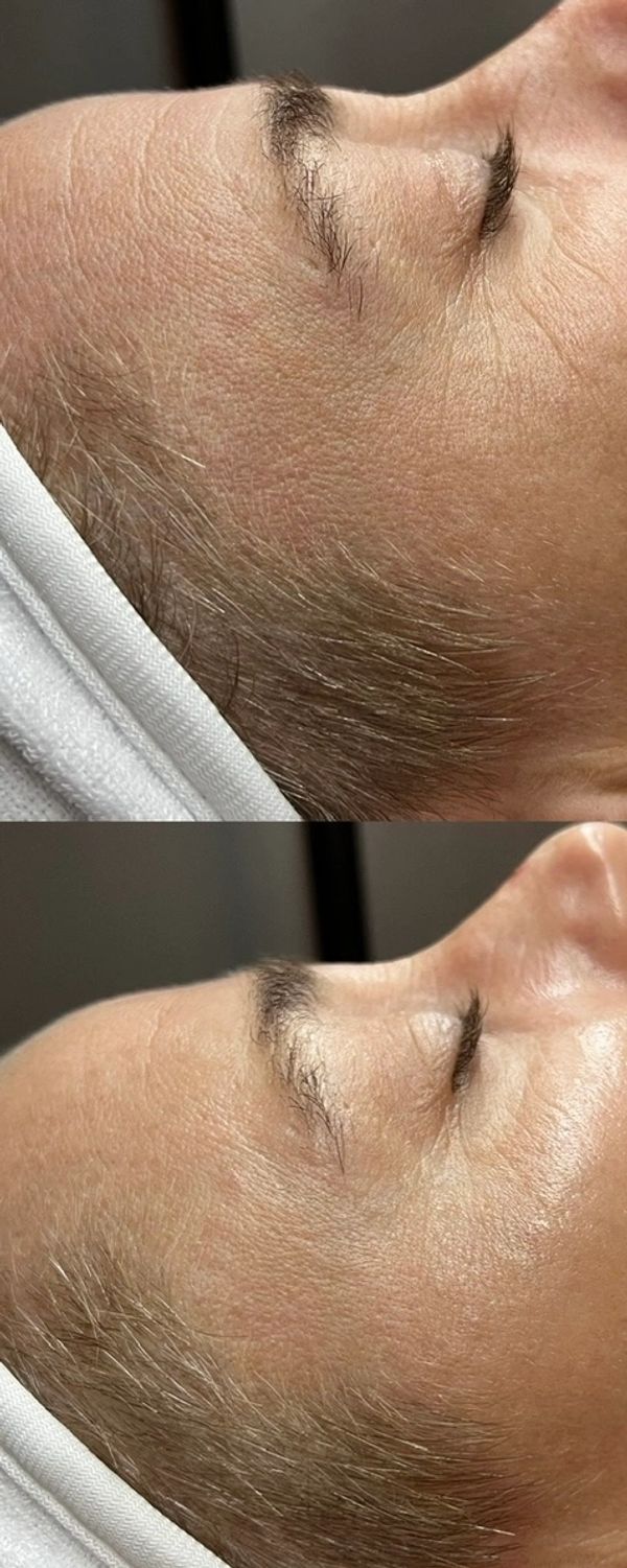 Anti-Aging "Botox" Facial