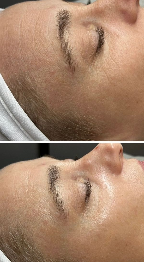 Anti-Aging "Botox" Facial
