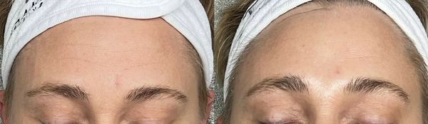 Anti-Aging "Botox" Facial