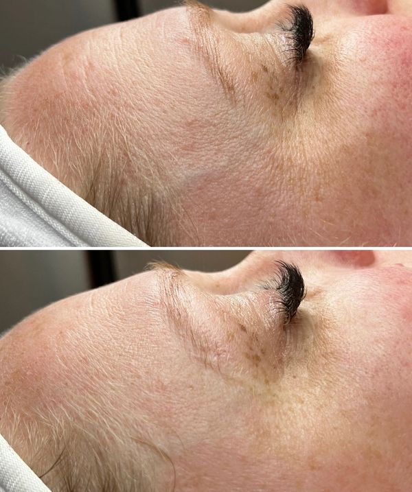 Anti-Aging "Botox" Facial