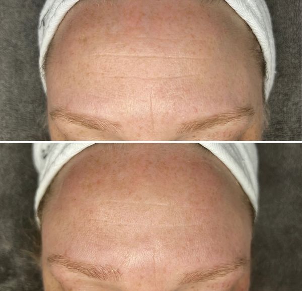 Anti-Aging "Botox" Facial
