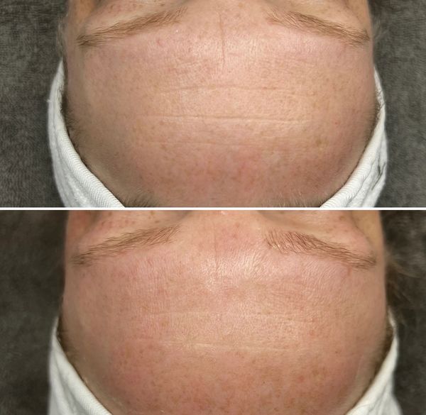 Anti-Aging "Botox" Facial