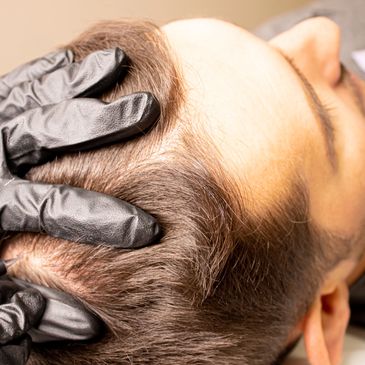 For those who have sparse hair in the crown area or hairline, we offer advanced techniques to make y