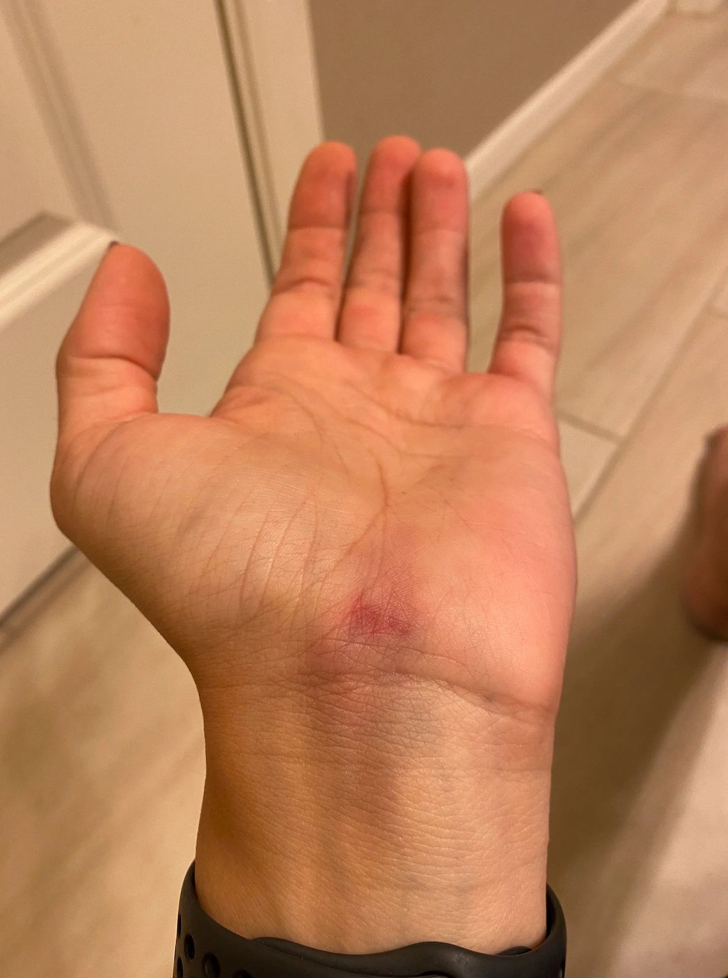 bruised knuckles from fighting
