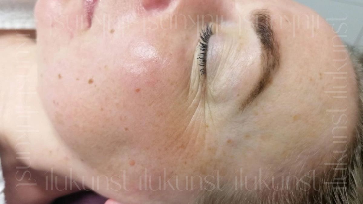 Klient pärast Signature FaceLift™ ensüümkoorimine koos LED valgusteraapiaga Ilukunsti stuudios.

