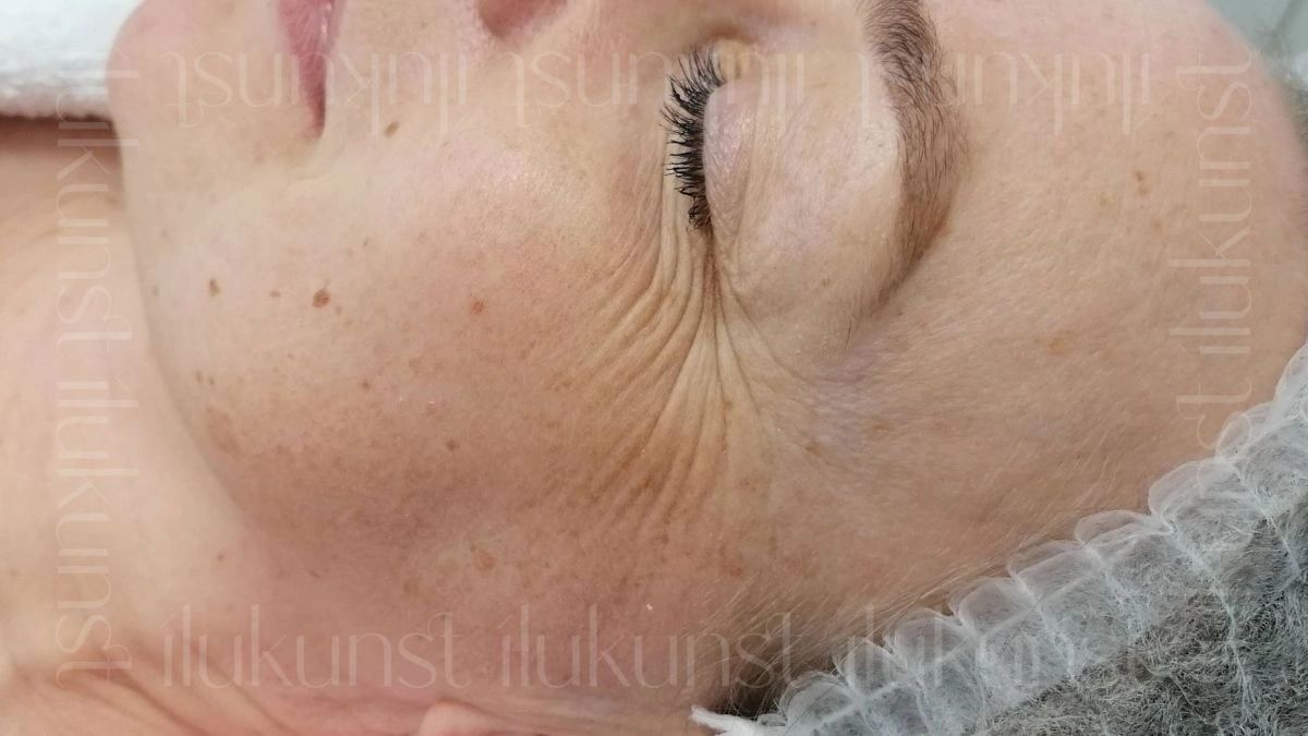 Klient enne Signature FaceLift™ ensüümkoorimist koos LED valgusteraapiaga Ilukunsti stuudios.
