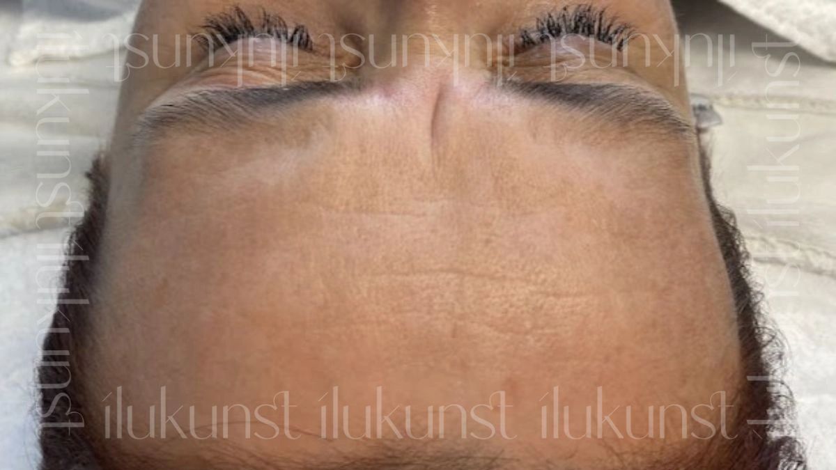 Klient enne Thesera H Hydroglow näohooldust Ilukunsti stuudios Tallinnas. 