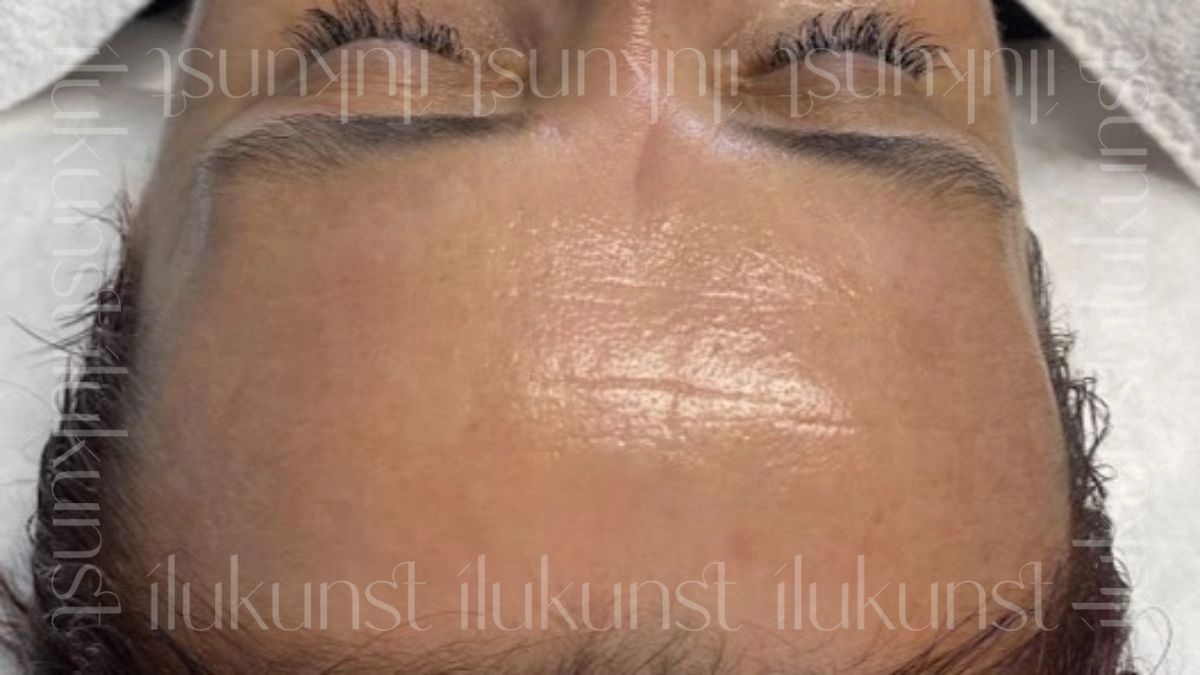 Klient koheselt pärast Thesera H Hydroglow näohooldust Ilukunsti stuudios Tallinnas. 